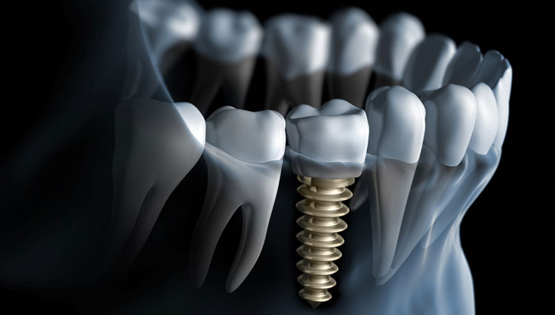 Europe Dental Implants Market Size, Share, Growth and Analysis Report 2021-2026