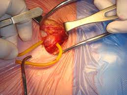 Hernia Repair Market Growth 2022-2027, Industry Size, Share, Trends and Forecast